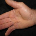 dupuytren-contracture-01__protectwyjqcm90zwn0il0_focusfillwzi5ncwymjisingildfd-2450075-9748932-jpg-8333606