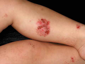 Dermatitis atópica numular infectada