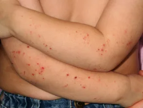 Jeukende atopische dermatitis