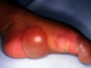 epidermolysis bullosa