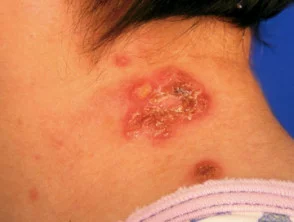 epidermolysis bullosa