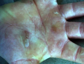 epidermolysis bullosa