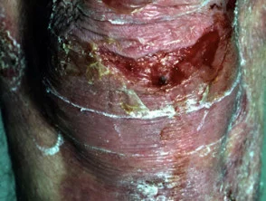 epidermolysis bullosa