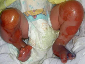 epidermolysis bullosa