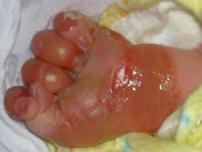 epidermolysis bullosa