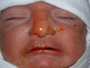 epidermolysis bullosa