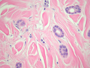Patología del carcinoma ecrino