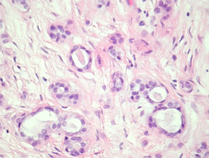 Patología tumoral mixta ecrina