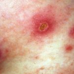 ecthyma__protectwyjqcm90zwn0il0_focusfillwzi5ncwymjisinkildfd-3329501-7926700-jpg-9904442