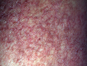Eczema craquele