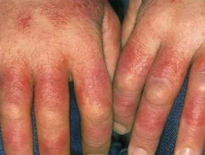 Allergische contactdermatitis van de handen. 