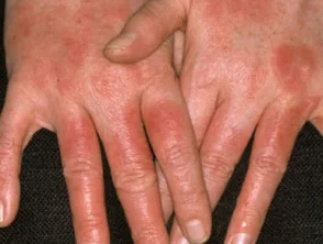 Allergische contactdermatitis van de handen. 