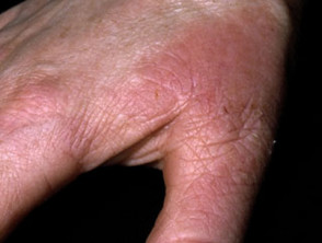 Dermatitis alérgica de contacto de las manos. 