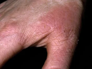 Allergische contactdermatitis van de handen. 