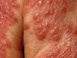 Allergische contactdermatitis van de handen. 