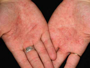 Dermatitis crónica de la mano