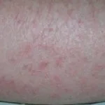 eczema-craquele1__protectwyjqcm90zwn0il0_focusfillwzi5ncwymjisingildfd-7510406-8491292-jpg-1285320
