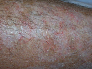 Eczema craquelé