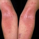 eczema-elbows-001__protectwyjqcm90zwn0il0_focusfillwzi5ncwymjisingildjd-4058502-8248349-jpg-3992336