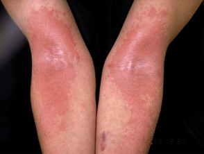 eczema-elbows-001__protectwyjqcm90zwn0il0_focusfillwzi5ncwymjisingildjd-4058502-8248349-jpg-3992336