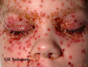 eczema-herpticum01__protectwyjqcm90zwn0il0_focusfillwzi5ncwymjisinkildewxq-6334464-7285293-jpg-7392682