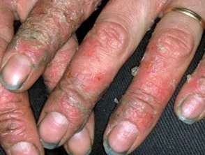 Allergische contactdermatitis van de handen. 