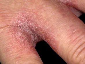 Allergische contactdermatitis van de handen. 