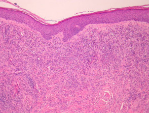 Pathologie des Erythema Elevatum diutinum