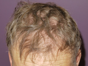 Alopecia por vemurafenib