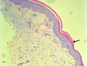 Patología del eritema gyratum repens