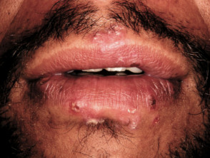 Herpes labial simple asociado con eritema multiforme