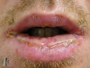 Eritema multiforme de labios.