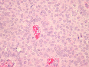 Patología del carcinoma de glándulas sudoríparas endocrino productor de mucina