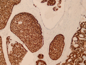 Patología del carcinoma de glándulas sudoríparas endocrino productor de mucina