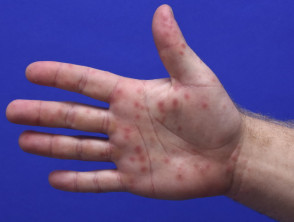 Infección por enterovirus: ampollas en la mano