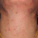 eos-folliculitis1__protectwyjqcm90zwn0il0_focusfillwzi5ncwymjisingildfd-3503252-7620103-jpg-5679702