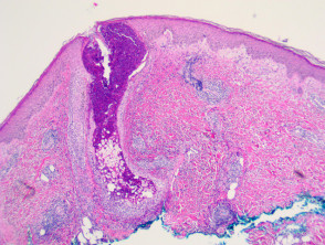 Patologia della follicolite pustolosa eosinofila
