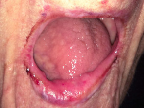 Úlcera eosinofílica del labio