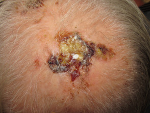 Dermatosis pustulosa erosiva