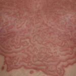 erythema-gyratum-repens-01__protectwyjqcm90zwn0il0_focusfillwzi5ncwymjisingildfd-5453864-4968292-jpg-5865958