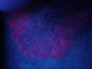 Fluorescencia del eritrasma