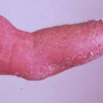 erythroderma1__protectwyjqcm90zwn0il0_focusfillwzi5ncwymjisingildfd-6779193-9396025-jpg-1613764