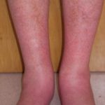 erythromelalgia-02__protectwyjqcm90zwn0il0_focusfillwzi5ncwymjisinkildg1xq-9462143-5766018-jpg-7549123