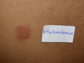 Dermatitis de contacto a etilendiamina
