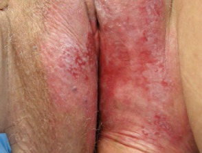 Enfermedad de Paget extramamaria de la piel de la vulva