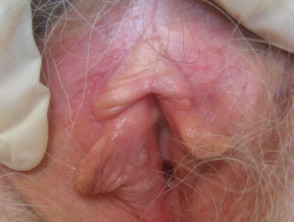 Enfermedad de Paget extramamaria de la piel de la vulva