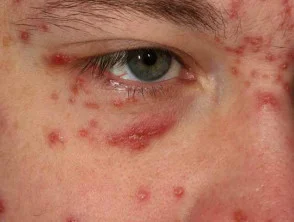 Acne agminata rond het ooglid