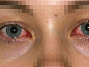Afectación ocular en el síndrome de Stevens Johnson