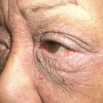 eyelid-dermatitis-02__protectwyjqcm90zwn0il0_focusfillwzi5ncwymjisingildfd-7762542-3864128-jpg-4363339