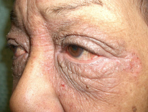 Dermatitis de contacto del párpado
